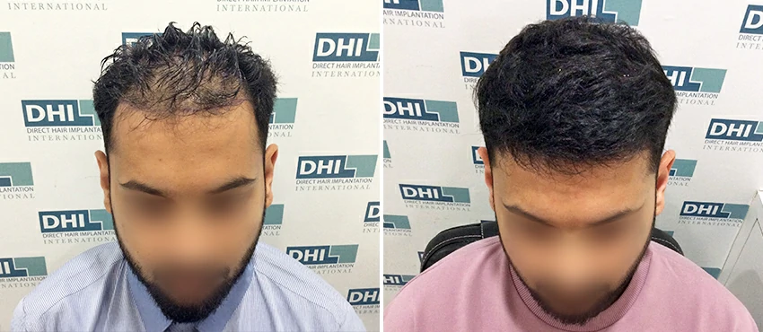 DHI before & after hair transplant results