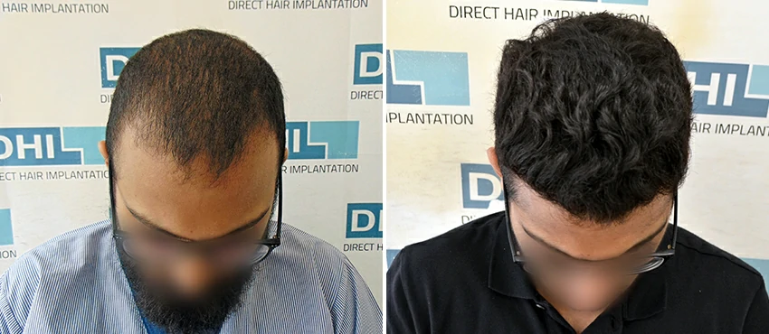 DHI before & after hair transplant results