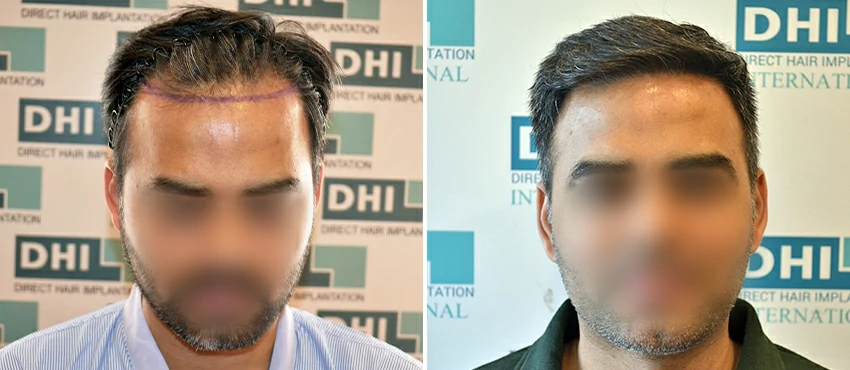 DHI before & after hair transplant results