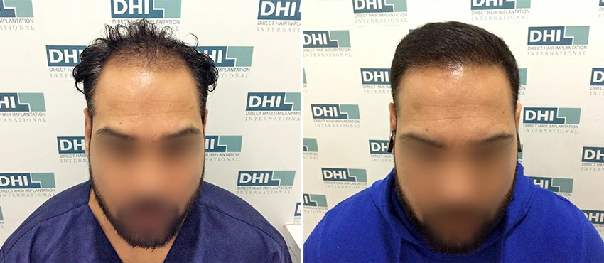 DHI before & after hair transplant results