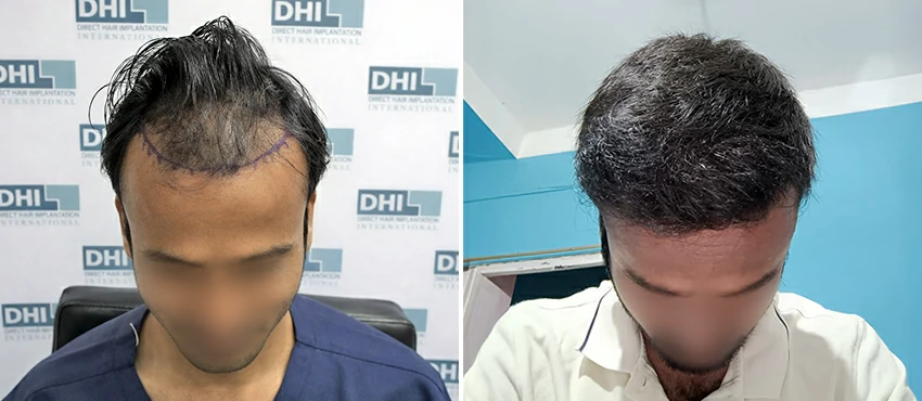 DHI before & after hair transplant results