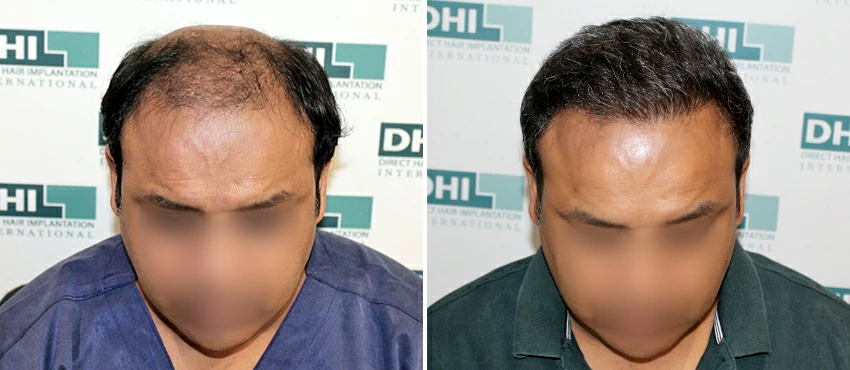 DHI before & after hair transplant results