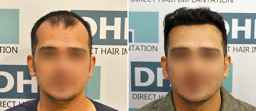 DHI before & after hair transplant results