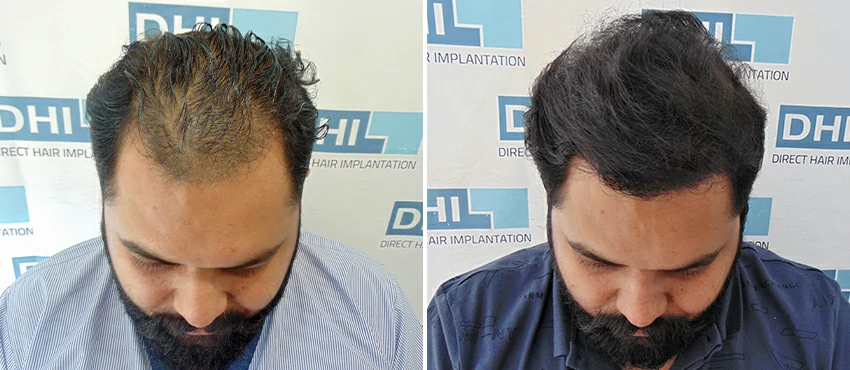 DHI before & after hair transplant results