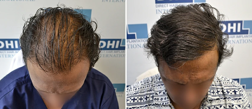 DHI before & after hair transplant results