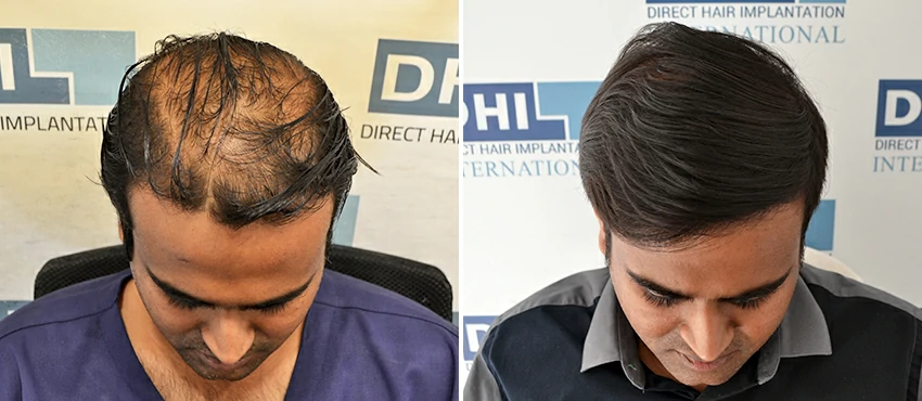 DHI before & after hair transplant results