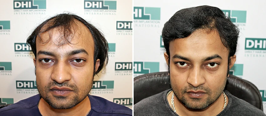 DHI before & after hair transplant results