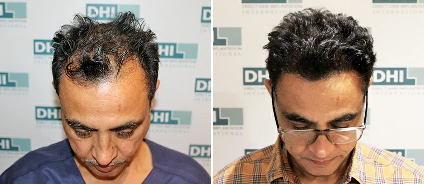 DHI before & after hair transplant results
