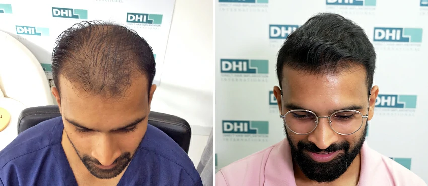 DHI before & after hair transplant results
