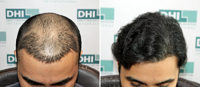 DHI before & after hair transplant results