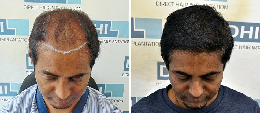 DHI before & after hair transplant results