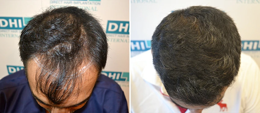 DHI before & after hair transplant results