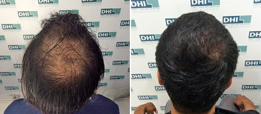 DHI before & after hair transplant results