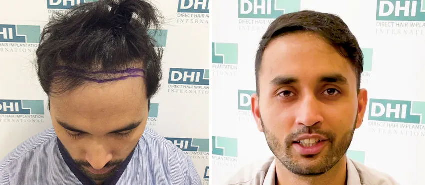 dhi gives natural hairline