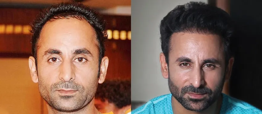 DHI before & after hair transplant results