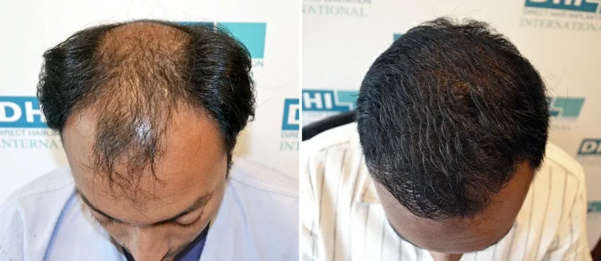 DHI before & after hair transplant results