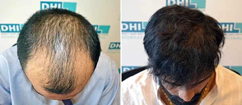 DHI before & after hair transplant results