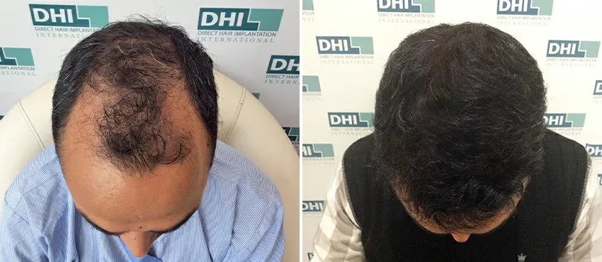 DHI before & after hair transplant results