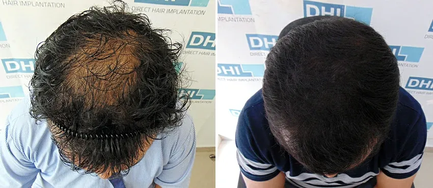 DHI before & after hair transplant results