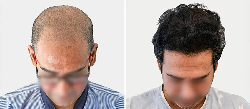 DHI before & after hair transplant results