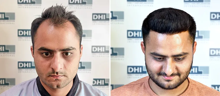 DHI before & after hair transplant results