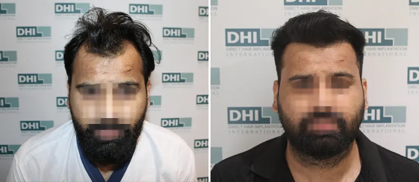 DHI before & after hair transplant results