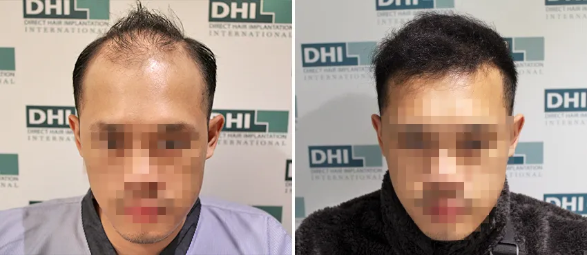 DHI before & after hair transplant results
