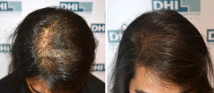Beard Transplant Before & After