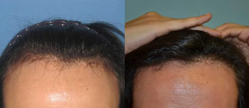 Female before and after hair transplant results
                                         