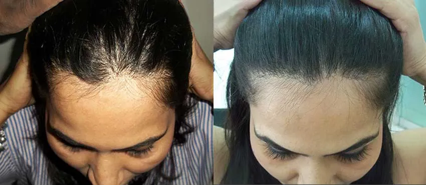 Female before and after hair transplant results