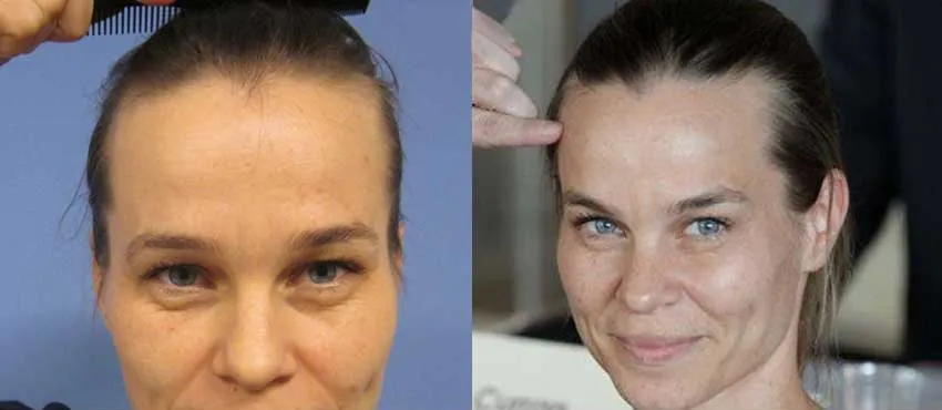 Female before and after hair transplant results
