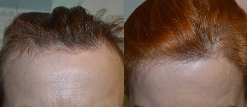 Female before and after hair transplant results