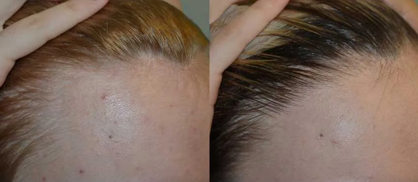 Female before and after hair transplant results