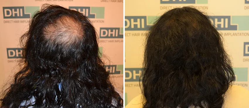 Female before and after hair transplant results