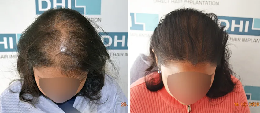Female before and after hair transplant results