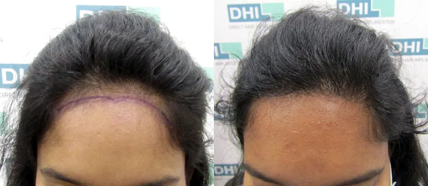Female before and after hair transplant results