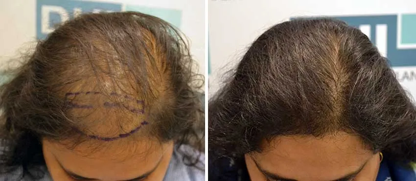 Female before and after hair transplant results