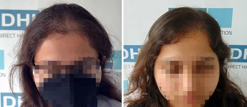 Female before and after hair transplant results