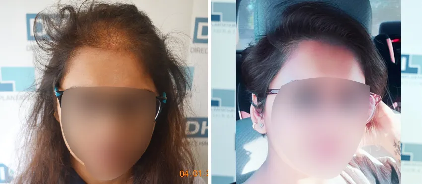 Female before and after hair transplant results