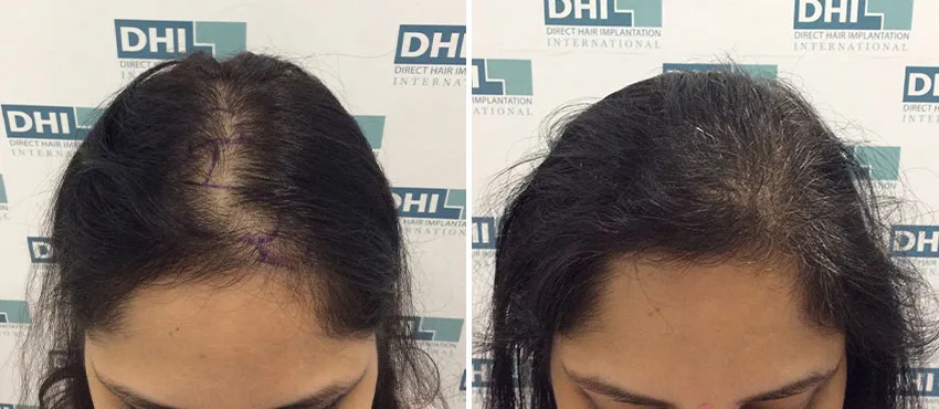Female before and after hair transplant results
