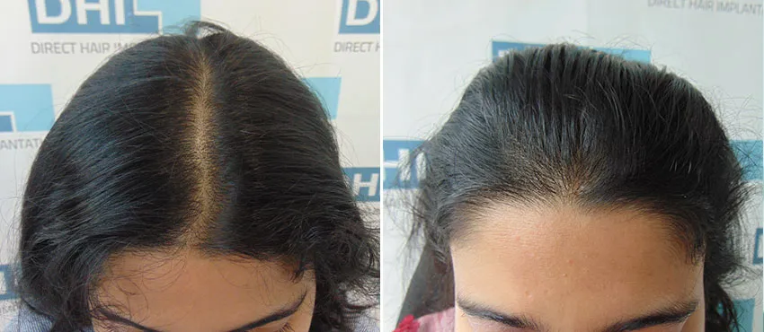 Female before and after hair transplant results