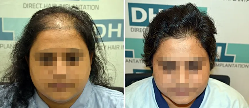 Female before and after hair transplant results