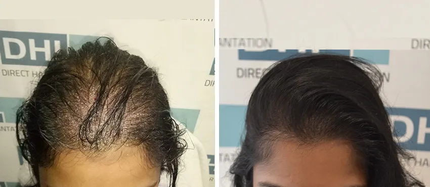 Female before and after hair transplant results
