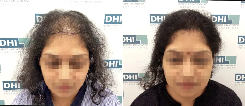Female before and after hair transplant results