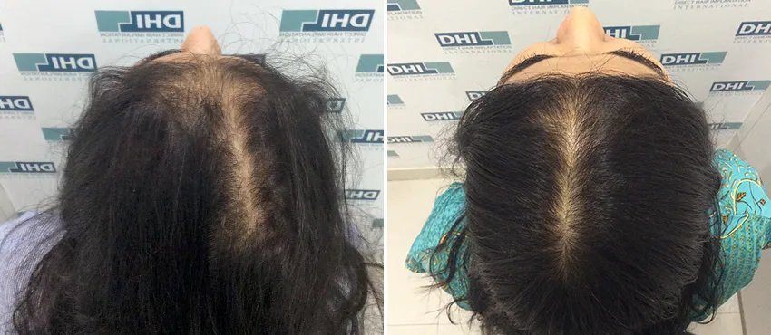 Female before and after hair transplant results
