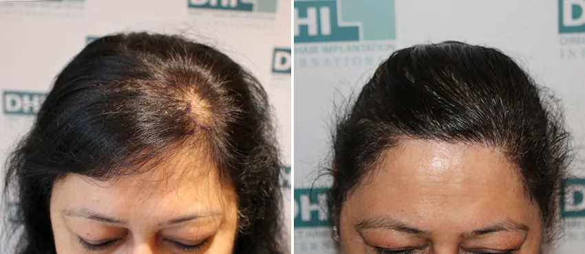 Female before and after hair transplant results