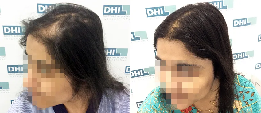 Female before and after hair transplant results
