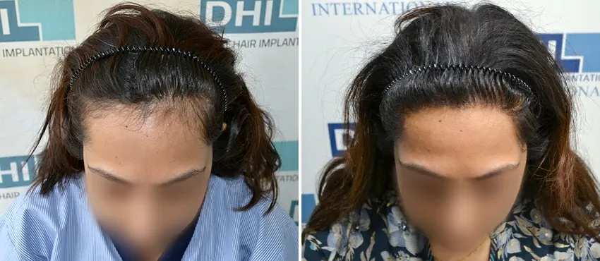 Female before and after hair transplant results