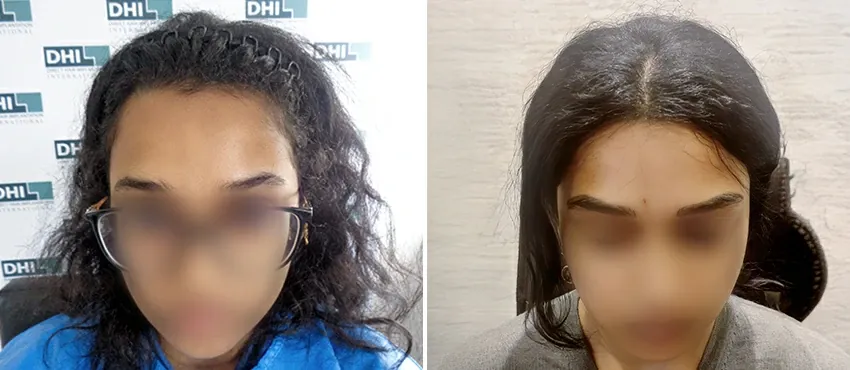 Female before and after hair transplant results