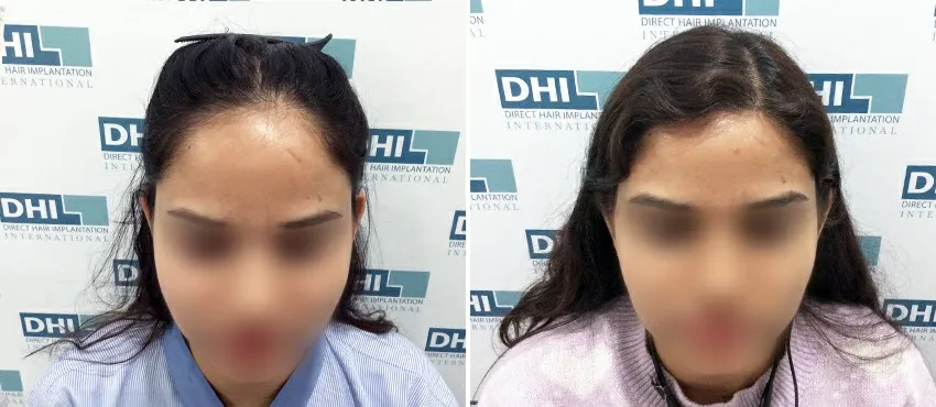 Female before and after hair transplant results